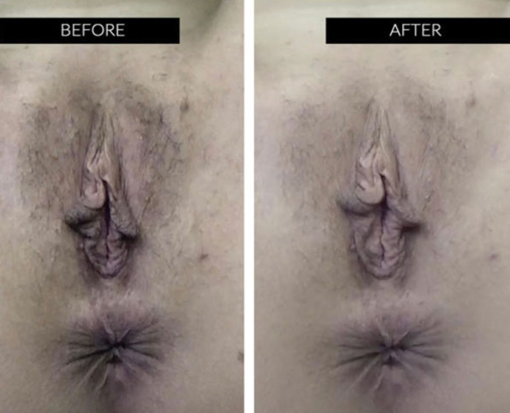 Anal Lightening Before and After: Real Transformations