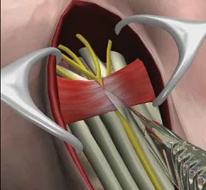 From Pain to Relief: Understanding the Process of Carpal Tunnel Surgery